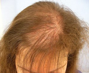 Female Baldness | The Glasgow Clinic