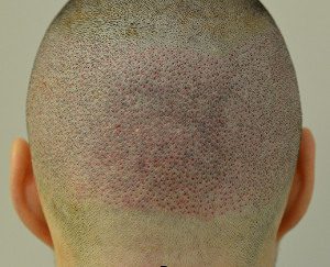 FUE Donor area immediately post op